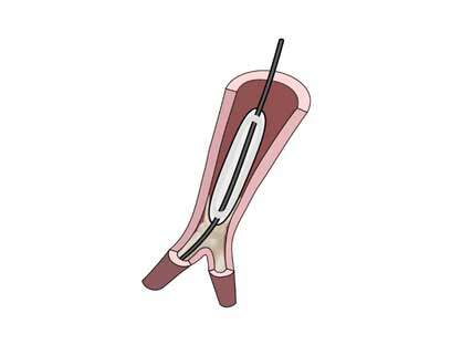 Balloon Pulmonary Angioplasty for Chronic Thromboembolic Pulmonary Hypertension