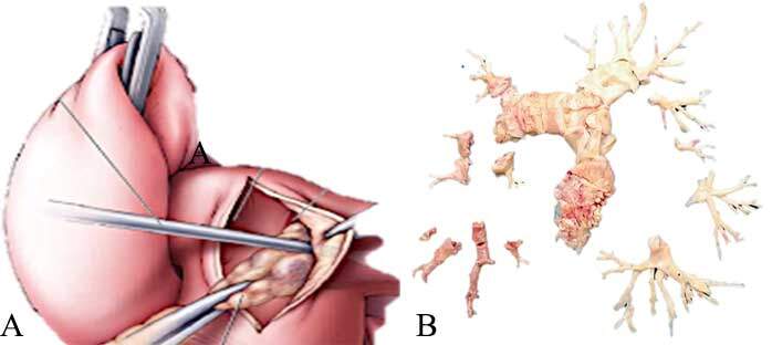 Pulmonary Endarterectomy for Chronic Thromboembolic Pulmonary Hypertension